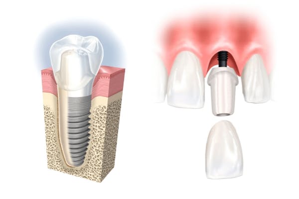 Zahnärztliche Chirurgie, Implantologie 